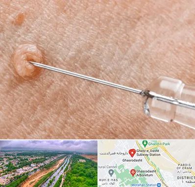 لیزر زگیل تناسلی در قصرالدشت شیراز 