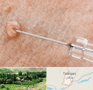 لیزر زگیل تناسلی در طالقان