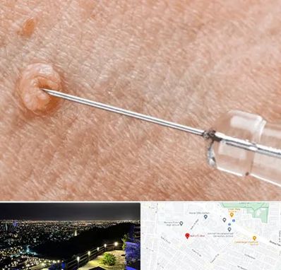 لیزر زگیل تناسلی در هفت تیر مشهد 