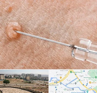 لیزر زگیل تناسلی در کوی وحدت شیراز 