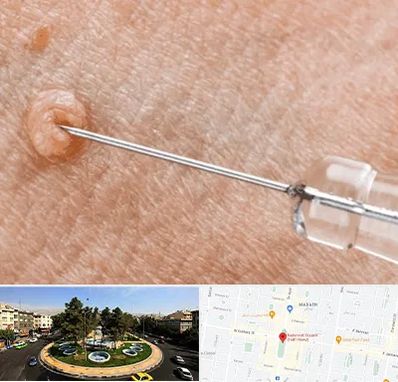 لیزر زگیل تناسلی در هفت حوض 