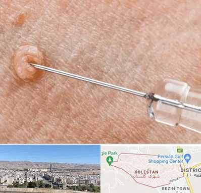 لیزر زگیل تناسلی در شهرک گلستان شیراز 