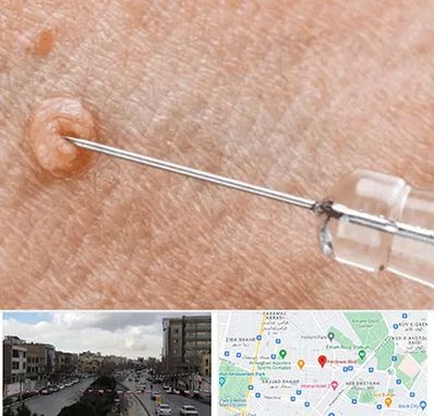 لیزر زگیل تناسلی در بلوار فردوسی مشهد 