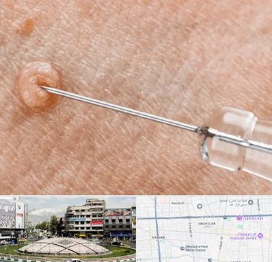 لیزر زگیل تناسلی در مرکز تهران