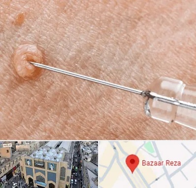 لیزر زگیل تناسلی در بازار رضا مشهد