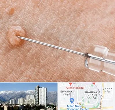 لیزر زگیل تناسلی در شهرک غرب 