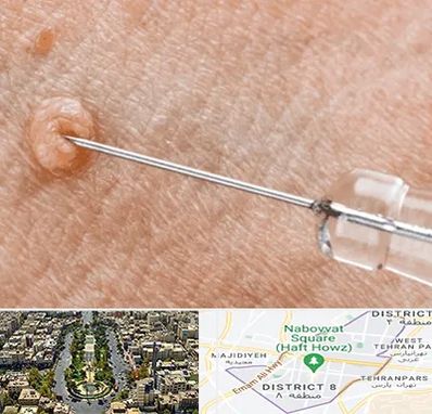 لیزر زگیل تناسلی در نارمک 