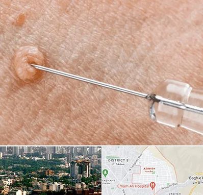 لیزر زگیل تناسلی در عظیمیه کرج 