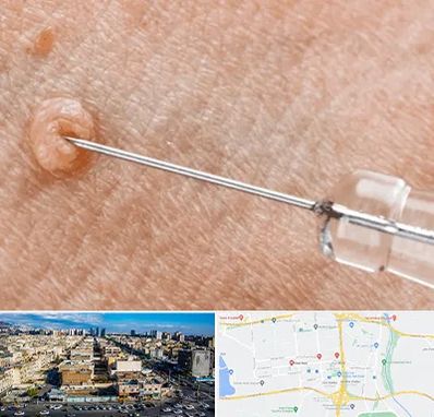 لیزر زگیل تناسلی در شهرک راه آهن 