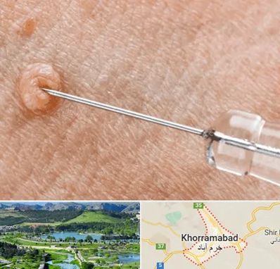 لیزر زگیل تناسلی در خرم آباد