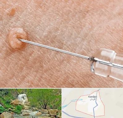 لیزر زگیل تناسلی در کردان