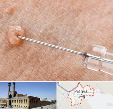 لیزر زگیل تناسلی در پیشوا