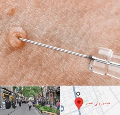 لیزر زگیل تناسلی در ولیعصر شهریار