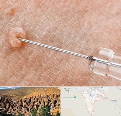 لیزر زگیل تناسلی در اسکو