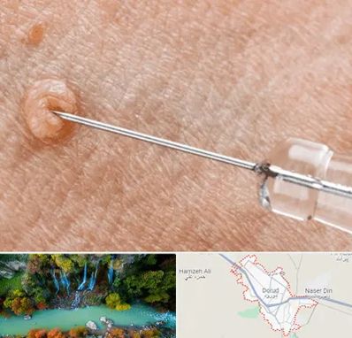 لیزر زگیل تناسلی در دورود