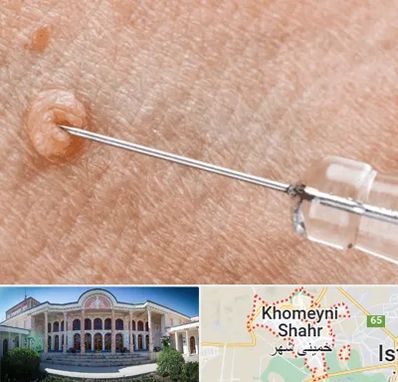 لیزر زگیل تناسلی در خمینی شهر