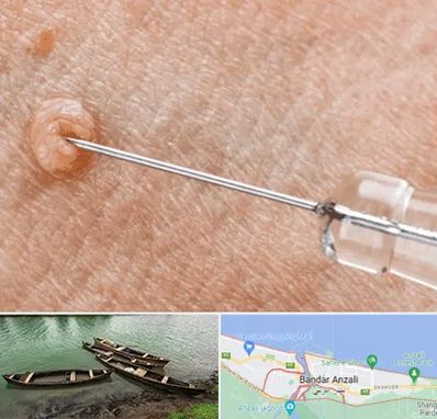 لیزر زگیل تناسلی در بندر انزلی