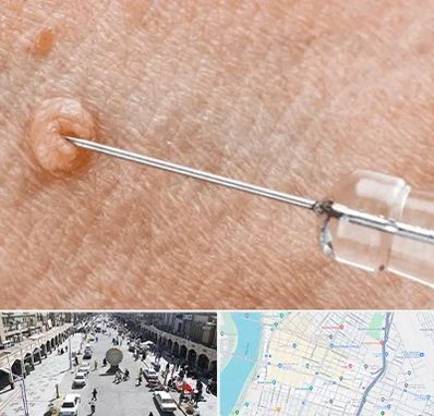 لیزر زگیل تناسلی در نادری اهواز 