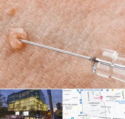 لیزر زگیل تناسلی در جمهوری 