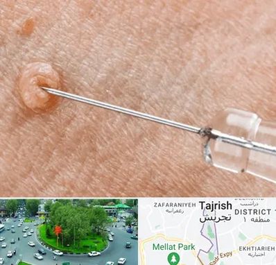 لیزر زگیل تناسلی در تجریش 