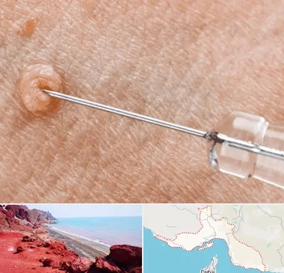 لیزر زگیل تناسلی در هرمزگان