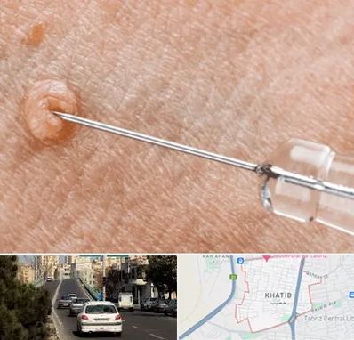 لیزر زگیل تناسلی در خطیب تبریز