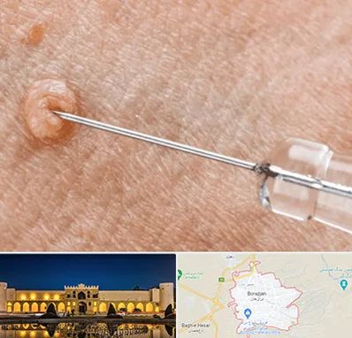 لیزر زگیل تناسلی در برازجان