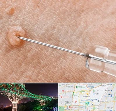 لیزر زگیل تناسلی در منطقه 3 تهران 