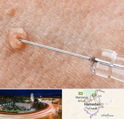 لیزر زگیل تناسلی در همدان