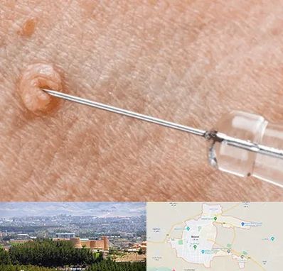 لیزر زگیل تناسلی در بیرجند