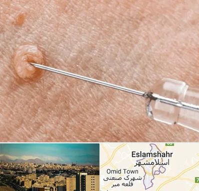 لیزر زگیل تناسلی در اسلامشهر