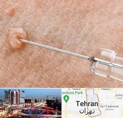 لیزر زگیل تناسلی در صادقیه 