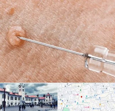 لیزر زگیل تناسلی در میدان شهرداری رشت 