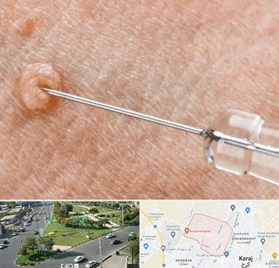 لیزر زگیل تناسلی در شاهین ویلا کرج 