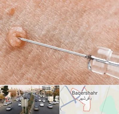 لیزر زگیل تناسلی در باقرشهر