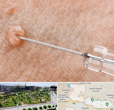 لیزر زگیل تناسلی در پردیس