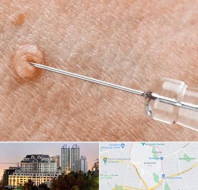 لیزر زگیل تناسلی در فرشته 