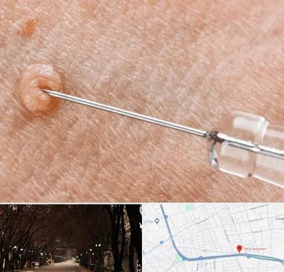 لیزر زگیل تناسلی در ابوریحان تبریز