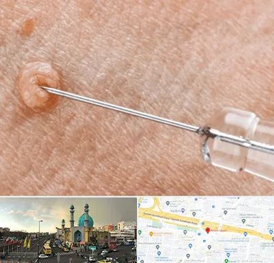 لیزر زگیل تناسلی در رسالت 