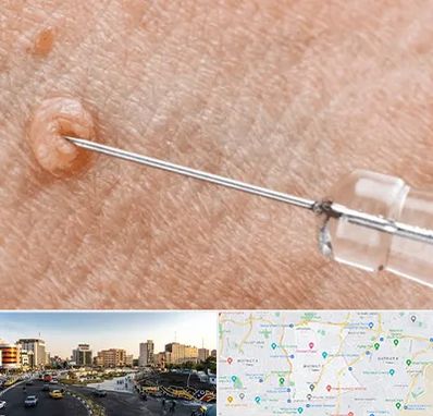 لیزر زگیل تناسلی در منطقه 7 تهران 