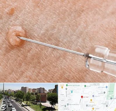 لیزر زگیل تناسلی در شهرک آزمایش 