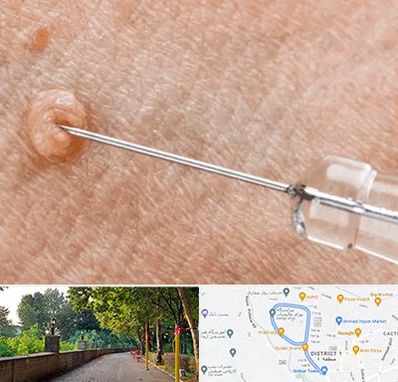 لیزر زگیل تناسلی در فلکه گاز رشت 