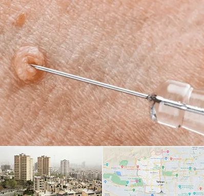 لیزر زگیل تناسلی در منطقه 5 تهران 