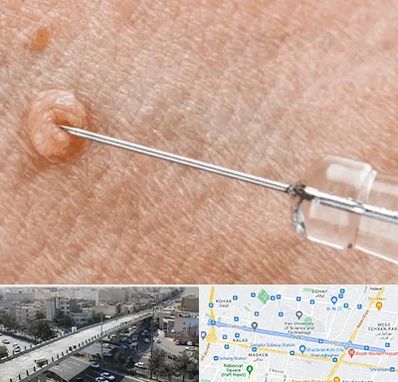 لیزر زگیل تناسلی در فرجام 