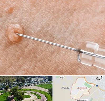 لیزر زگیل تناسلی در مهرشهر کرج 