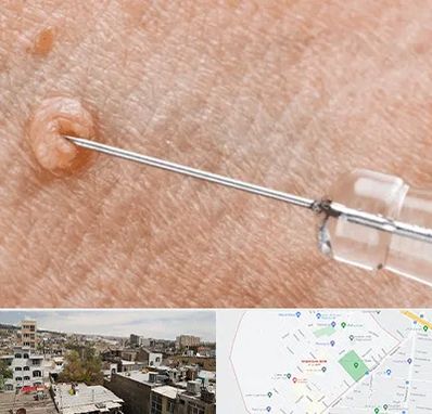 لیزر زگیل تناسلی در شمیران نو 