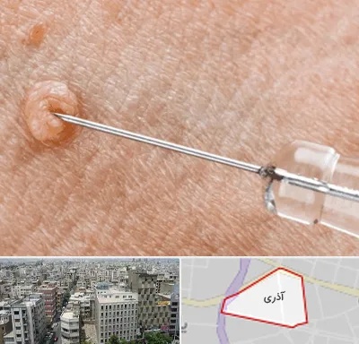 لیزر زگیل تناسلی در آذری