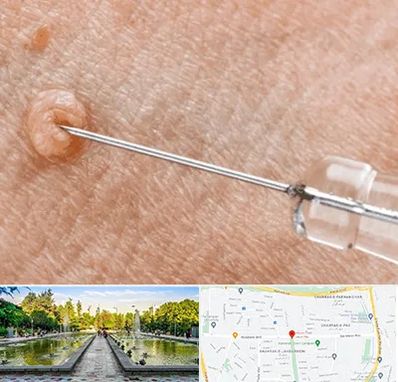 لیزر زگیل تناسلی در سرسبز 