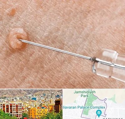 لیزر زگیل تناسلی در نیاوران 