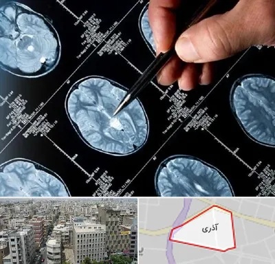 دکتر تشنج در آذری